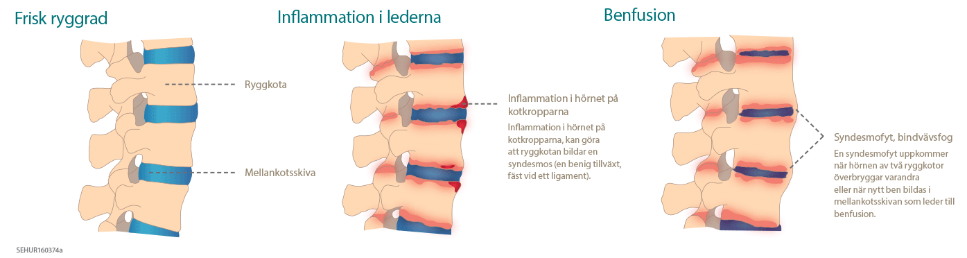 Schematisk bild över hur lederna drabbas vid AS