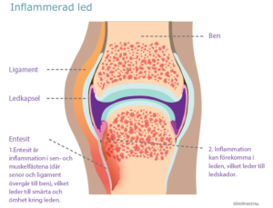 Schematisk bild över hur lederna drabbas vid psoriasisartrit